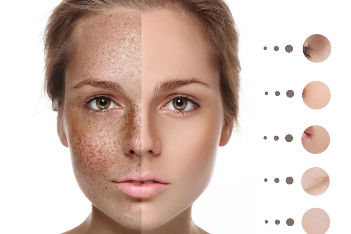 What Is Hyperpigmentation Laser Treatment A Quick Guide 