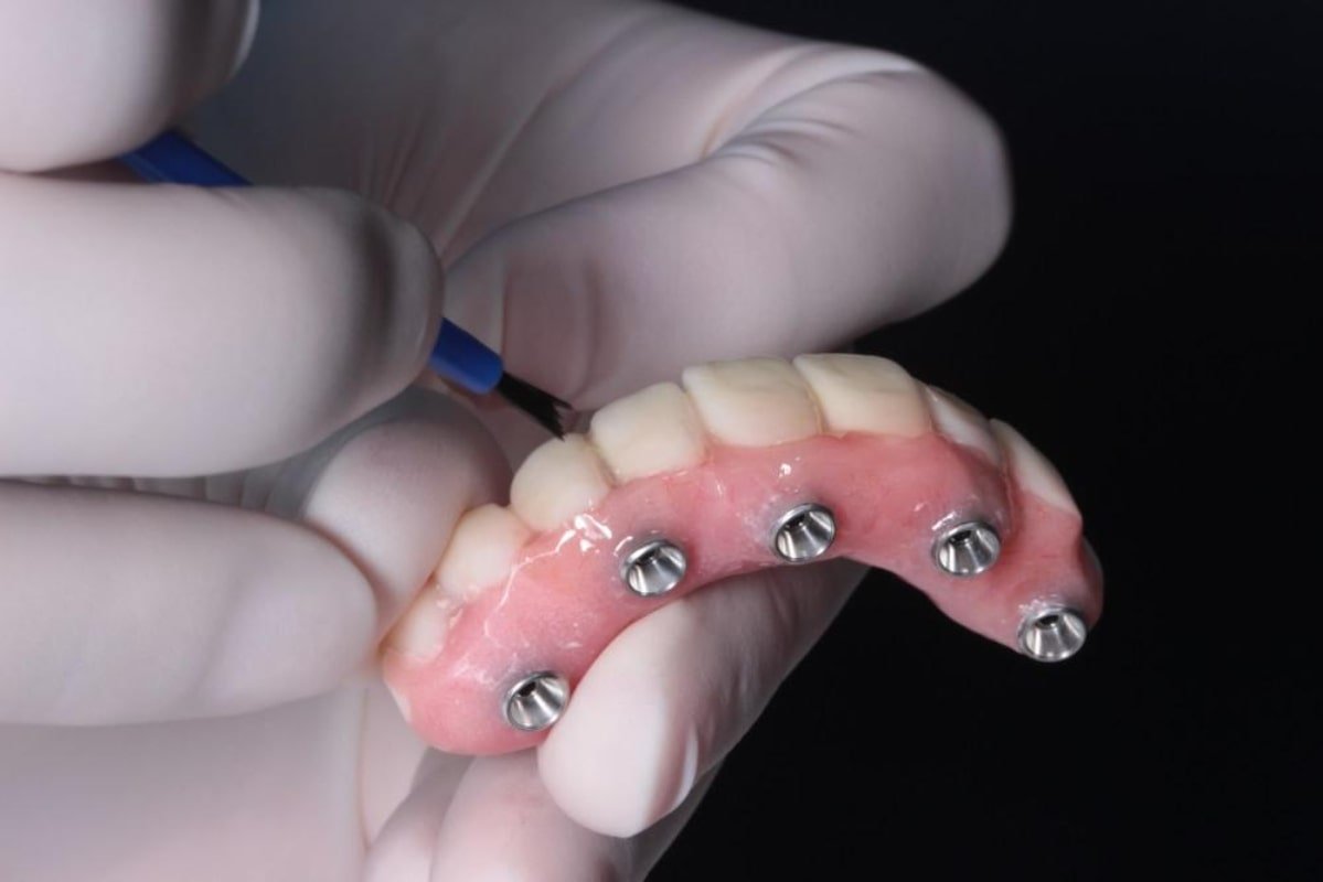 smile-makeover-on-4-method