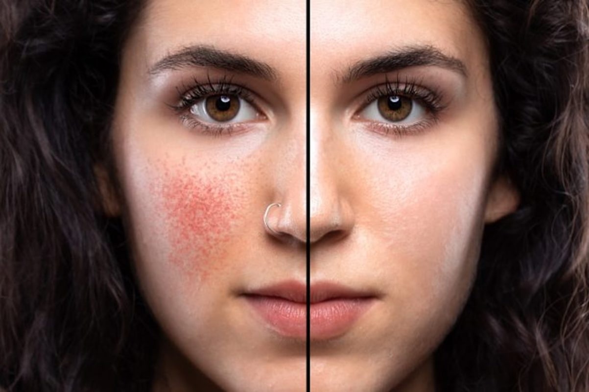 rosacea-skin-care-tips